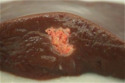 Nódulo blanquecino, encapsulado, intraparenquimatoso en el hígado. 