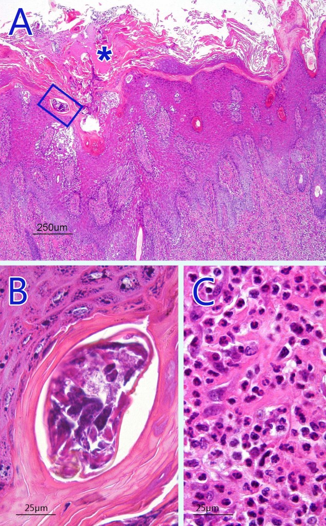 A photomicrograph of a hematoxylin-eosin stain where one can observe an intense hyperkeratosis (asterisk) and the presence of a mite in the stratum corneum (blue box, extended in image B). C: Detail of the inflammatory infiltrate, rich in polymorphonuclear  eosinophilic leukocytes, observed in the dermis.