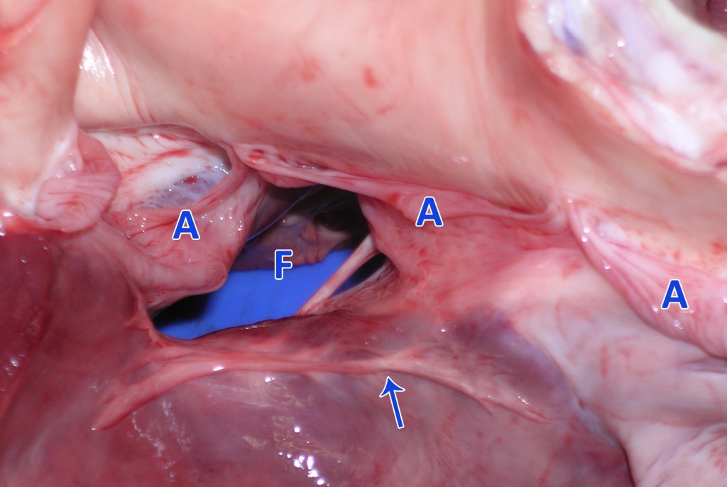 Vista des de l’interior del ventricle esquerre. Es pot observar el defecte de tancament  (F) al septe interventricular per sota de les valves semilunars (A) de la vàlvula aòrtica. La sageta assenyala una trabècula fibrosa que apareixia a l’aspecte ventral de la comunicació interventricular.