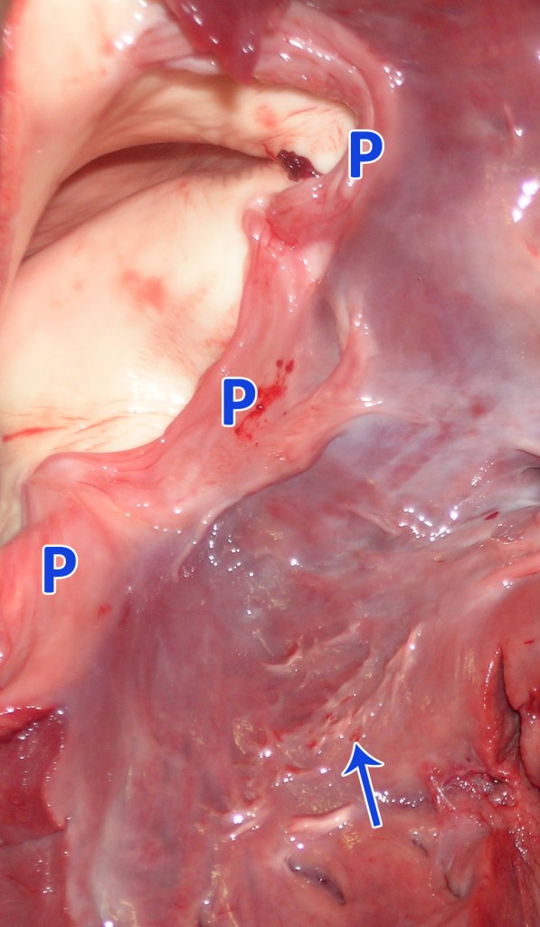 Vista de l’entrada de l’arteria pulmonar des de l’interior del ventricle dret. Es poden observar les tres valves semilunars (P) de la vàlvula pulmonar. La sageta assenyala lesions endocàrdiques de tipus fibrós probablement degudes al flux turbulent causat per la malformació del septe interventricular.