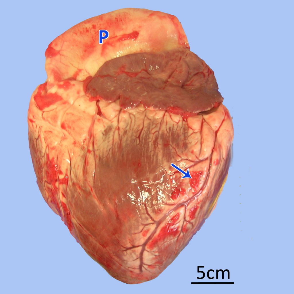 Cor de mida augmentada. Marcada dilatació de l’arteria pulmonar (P) i presència de múltiples adherències fibroses a la superfície epicàrdica (sageta).