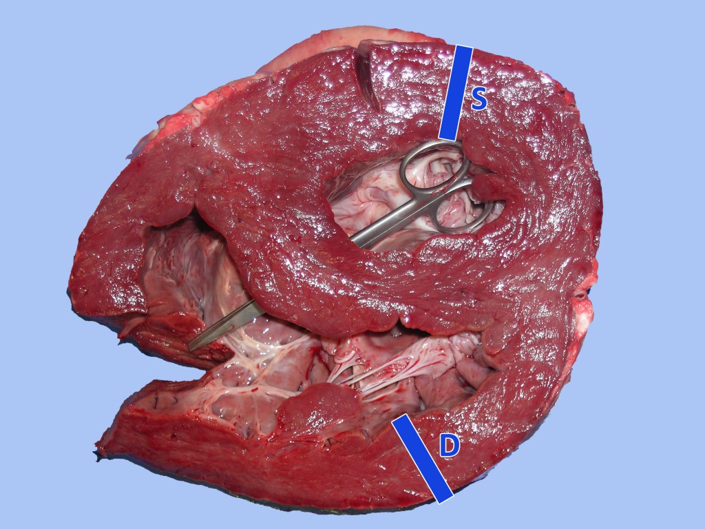 Les tisores demostren la comunicació existent entre les dues cavitats ventriculars. Les dues barres blaves mesuren 3,5 cm i corresponen a la gruixària de la paret del ventricle esquerre (S) i la del ventricle dret (D) la relació de gruix de les dues parets és 1:1 (normalment hauria de ser aproximadament de 1:3 D:S).