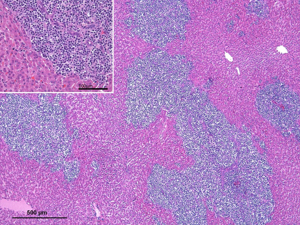Photomicrograph of an hematoxylin and eosin stained slide. One can see the characteristic lymphomatous infiltrate (blue) infiltrating the liver parenchyma (pink). Top left: enlarged detail of the infiltrating cell population.