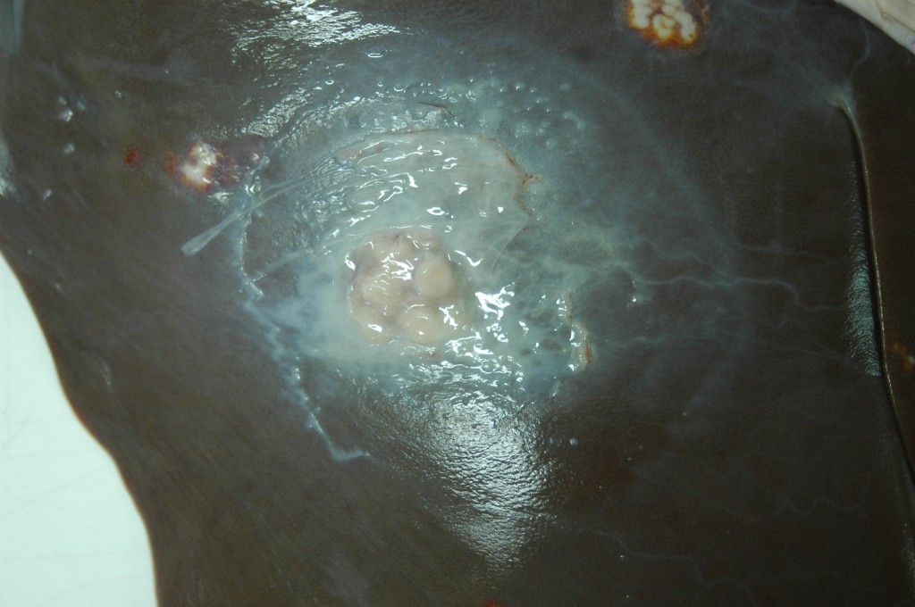 Múltiples lesions nodulars que profunditzen en el parènquima hepàtic.