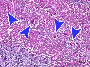Micrografía d’hematoxil•lina eosina. Es pot observar la reacció inflamatòria al voltant d’ous del nemàtode hepàtic Calodium hepaticum (Capillaria hepatica) (sagetes).