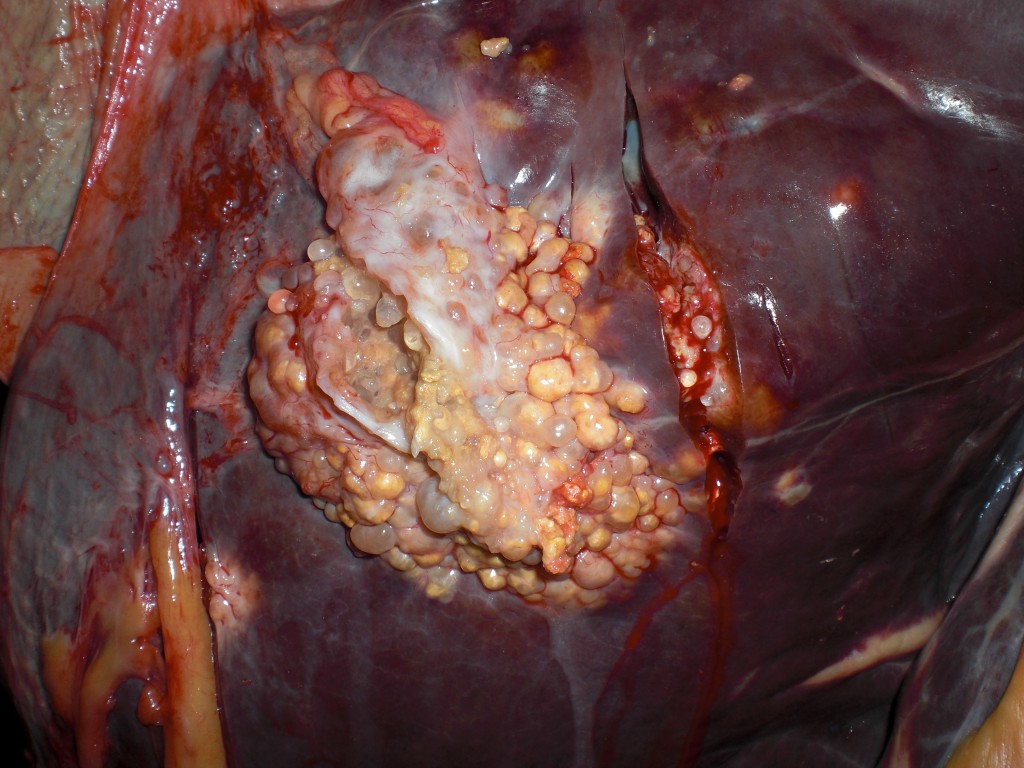 Lesión focal, que infiltra el parénquima hepático, constituida por múltiples vesículas de contenido seroso o purulento.