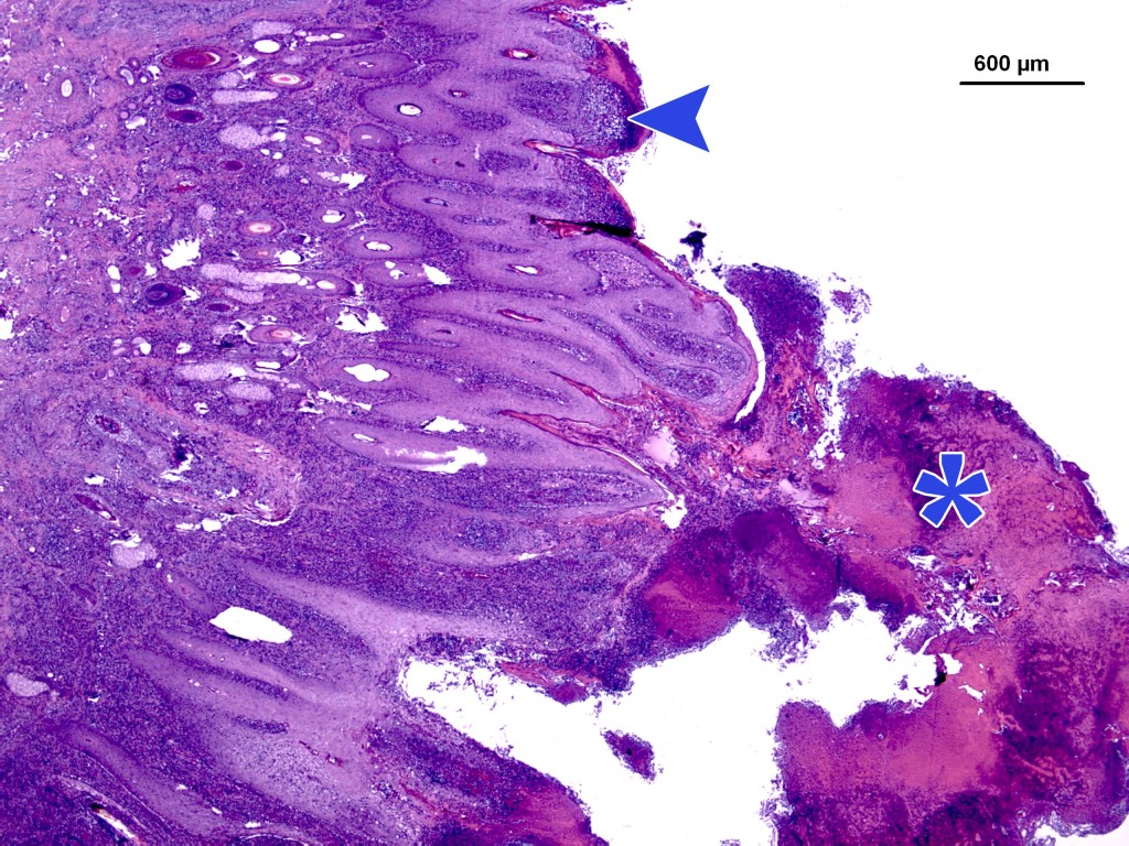 Microfotografia amb tinció d’Hematoxil•lina Eosina. Epidermis labial hiperplàsica i amb hiperqueratosi. S’observen pústules subcòrnies (sageta) i crostes superficial gruixudes (asterisc).