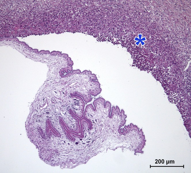 Microfotografia amb tinció d’Hematoxil·lina Eosina. A més augments podem observar amb major detall el paràsit i la reacció piogranulomatosa que genera (asterisc).