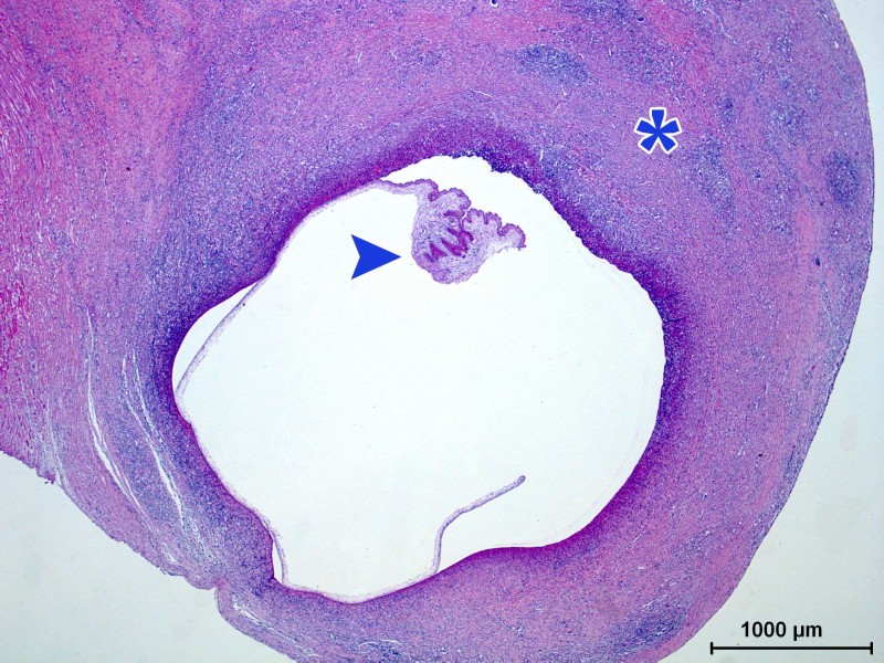 Microfotografia amb tinció d’Hematoxil·lina Eosina. A pocs augments podem observar el quist format per una cavitat que conté el paràsit (sageta) envoltada per una càpsula fibrosa (asterisc) amb una intensa reacció inflamatòria rica en leucòcits polimorfonucleats eosinòfils.