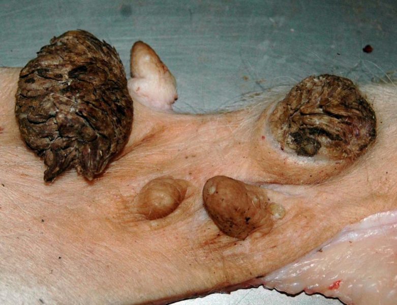 Pigmented skin nodules near the nipples. Pigmented skin nodules near the nipples.