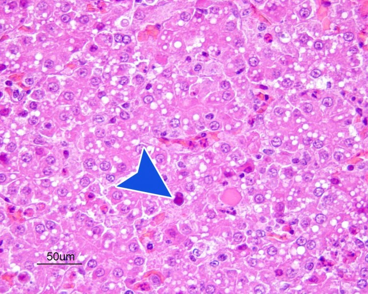 Hepatocito con un cuerpo de inclusión intranuclear eosinofílico, característico de esta patología.