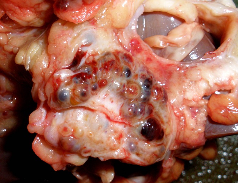 Lesió neoplàsica a la serosa peritoneal visceral. Les lesions són múltiples i quístiques, algunes amb contingut hemorràgic.