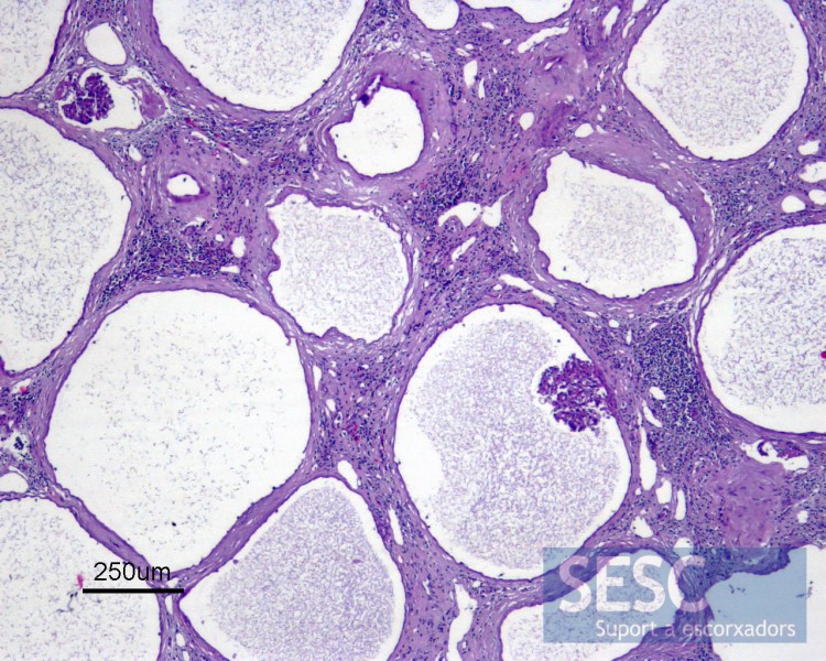 Some of the cystic cavities contained a renal glomerulus. The interstitium showed fibrosis and in some areas mononucelar inflammatory infiltrate.