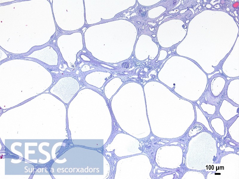 Microscopically, all cysts were lined with simple epithelium and among them a few scattered traces of apparently normal renal parenchyma could be observed.