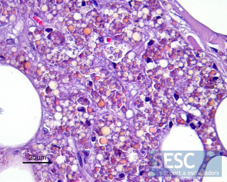 Microscòpicament s’aprecia aquesta imatge: cúmuls de pigments, probablement a l’interior de cèl•lules fagocitàries, entre adipòcits d’aspecte normal.