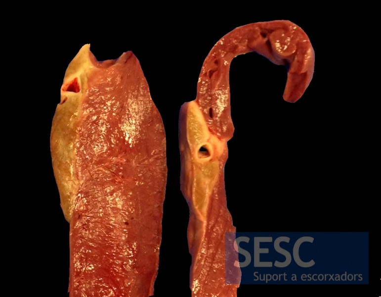 When sectioned it can be seen that the coloring affects the entire thickness of adipose tissue.