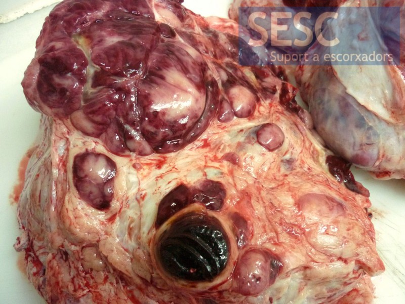 More closely you can see that the nodular proliferation invades the pericardium.