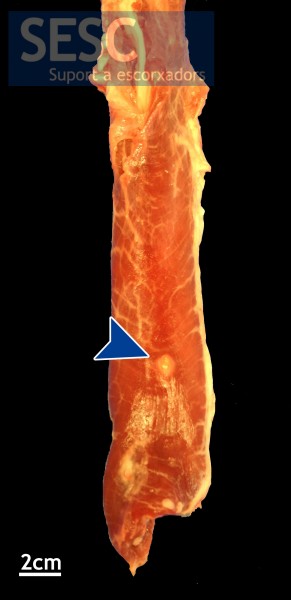 La sageta assenyala el nòdul blanquinós trobat a la musculatura de l’esòfag.