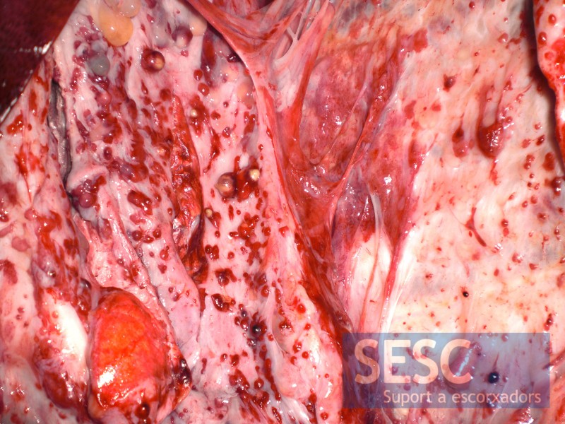 Image of the same lesion in the parietal pleura.