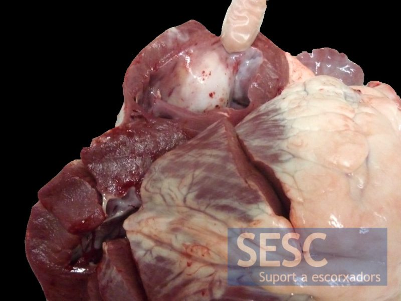 The finger points to the whitish nodule that protrudes into the ventricular cavity.