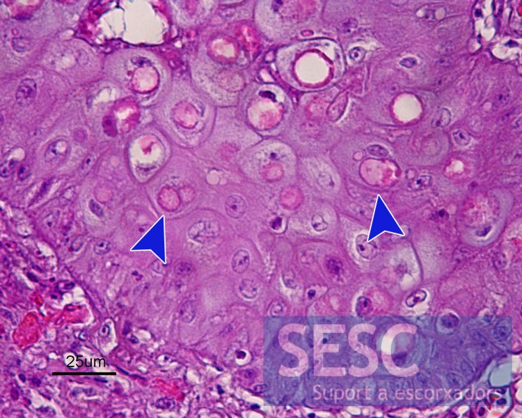 Multiple eosinophilic intracytoplasmic inclusion bodies (arrows) containing virus particles.