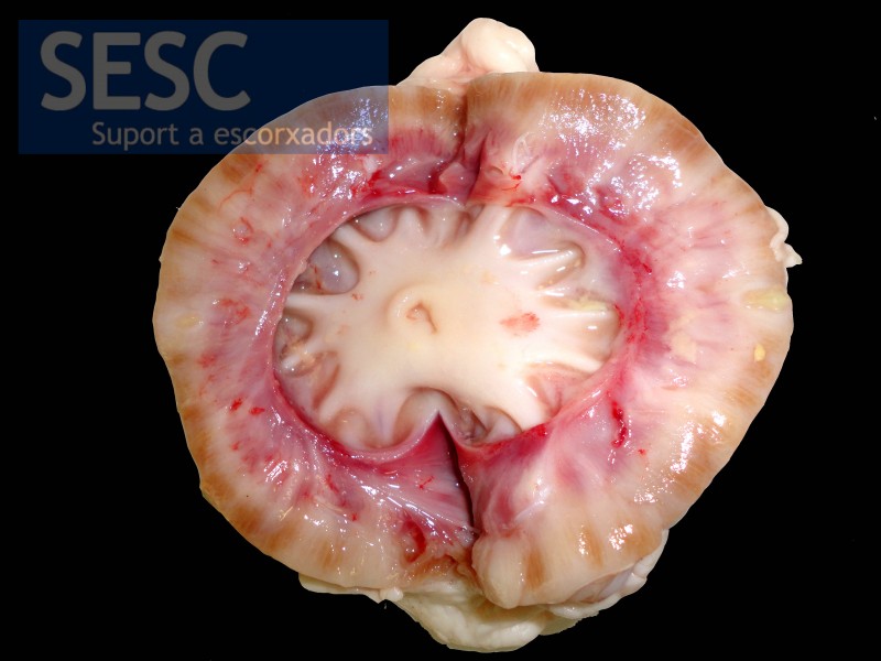 When sectioned, pallor and decreased renal cortex thickness could be observed.