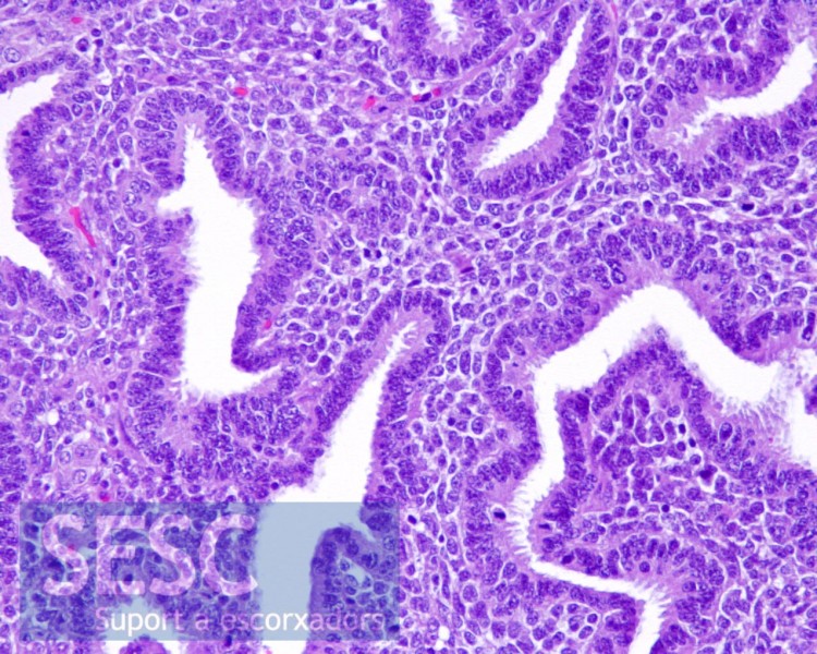 Detail of the primitive renal tubules. In this case differentiation into mesenchymal components which characterizes nephroblastomas was not observed.