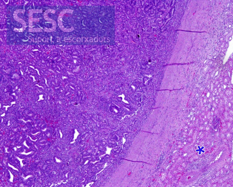 The neoplastic mass was sharply separated from the normal renal parenchyma (asterisk) by fibrous tissue capsule. The growth pattern was solid and densely cellular with formation of multiple primitive epithelial tubular structures.