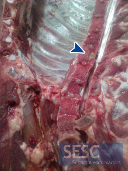 Case of vertebral osteomyelitis in the cervico-thoracic region.