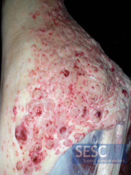 Múltiples lesions cutànies confluents i de coloració rosada.