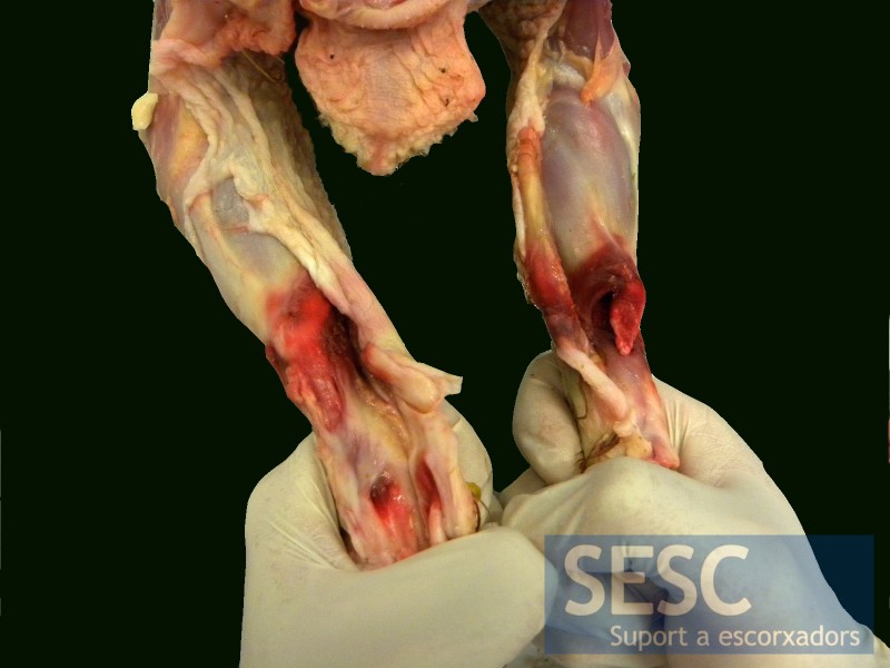 Hematomas a nivel de las articulaciones del tarso. Ruptura completa del tendón gastrocnemio izquierdo y parcial del derecho.