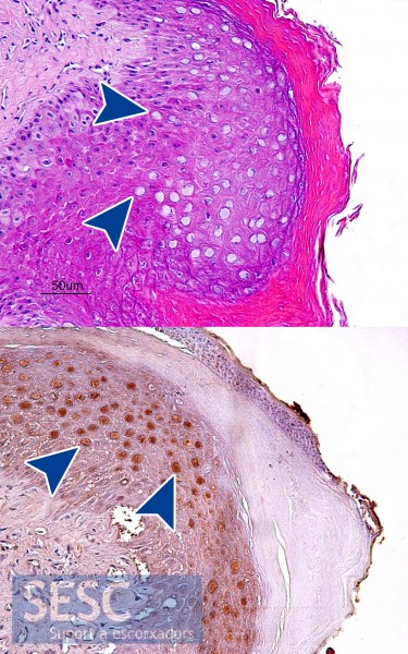 (A dalt) Imatge histològica de l’epiteli de la cresta amb inclusions intranucelars basòfiles que es tenyeixen positives (a baix) en una immunohistoquímica per papilomavirus. Les sagetes senyalen els cossos d’inclusió.