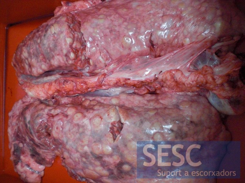 La lesión afecta a todos los lóbulos pulmonares y los linfonodos mediastínicos.