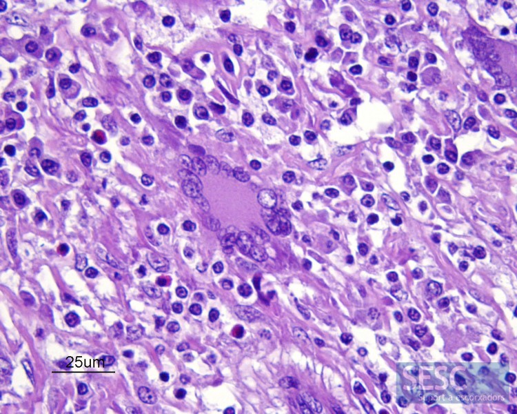 Al microscopio se puede observar una reacción inflamatoria granulomatosa con abundantes células gigantes multinucleadas como las de la imagen.