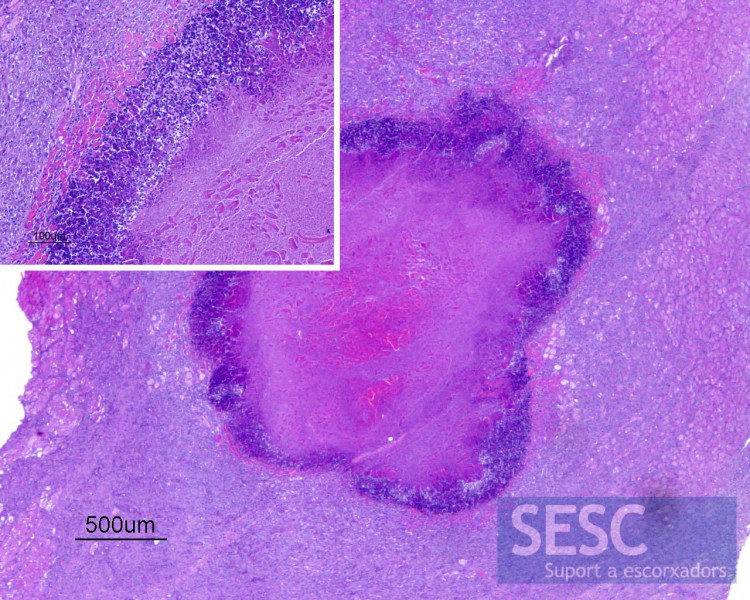 Microfotografia de la tinció d'Hematoxil·lina Eosina. Teixit muscular amb una lesió amb necrosi central rodejada d'un infiltrat inflamatori purulent i una reacció macrofàgica limfocítica amb evident activació vascular. 