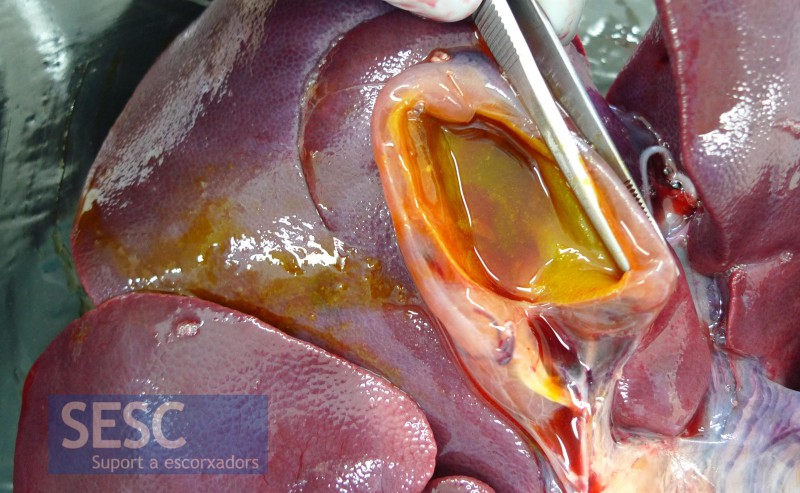 Another common lesion is edema of the gall bladder wall.