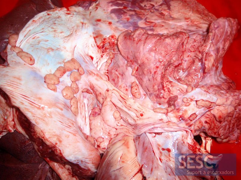 Lesiones nodulares blanquecinas en la pleura parietal y en pulmón.