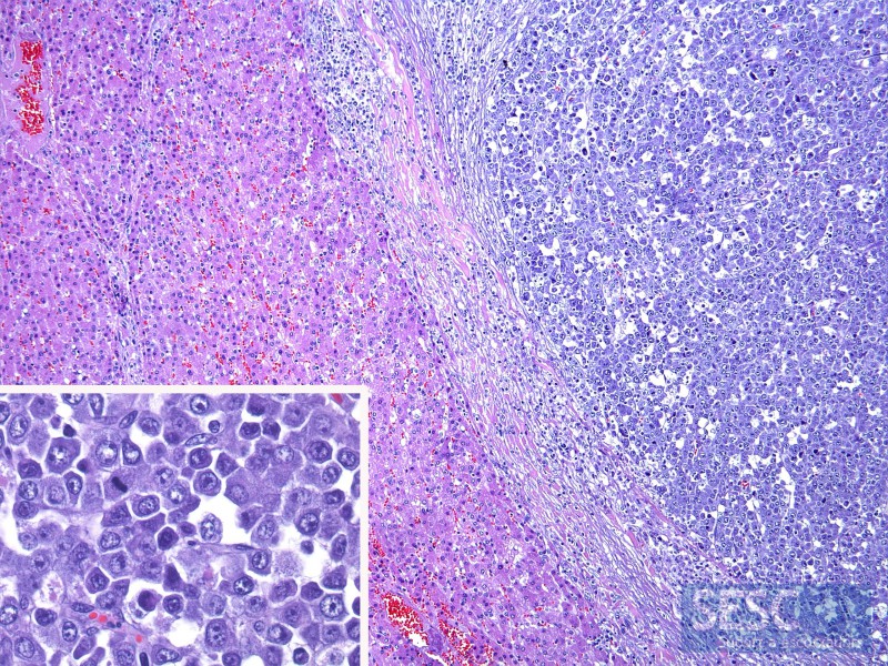 Imagen de la histopatología del hígado donde se muestra una proliferación de células redondas (parte superior izquierda, de color más azulado). A mayores aumentos se pueden observar las células neoplásicas.