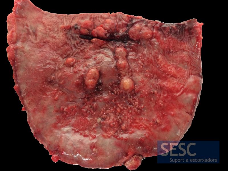 Nodular lesions in the spleen serosa.