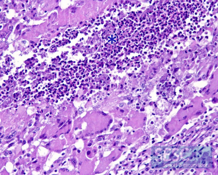 Histologically an intense suppurative infiltrate could be observed  (asterisk) but also the presence of abundant macrophages, some them multinucleated (lower half of the image).