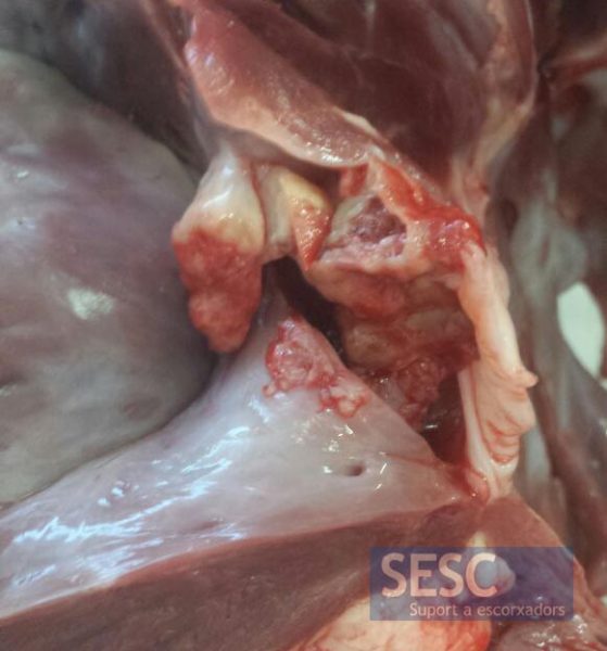 Lesiones en las válvulas atrio-ventriculares.