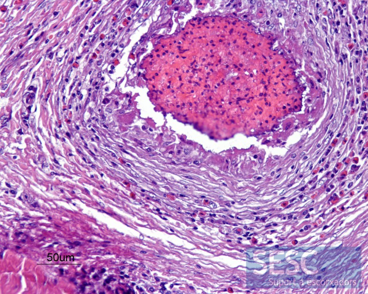 Miositis granulomatosa. Àrea necròtica central rodejada per fibrosi i infiltrat inflamatori ric en leucòcits polimorfonuclears eosinòfils. 