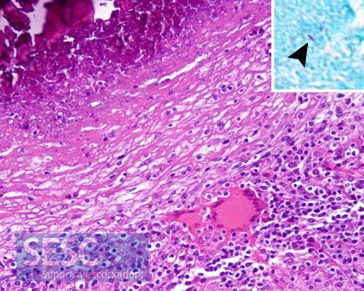 Estudi histopatològic B: Inflamació granulomatosa amb presència d'àrees de necrosi, cèl·lules gegants multinucleades i les estructures que assenyala la sageta.