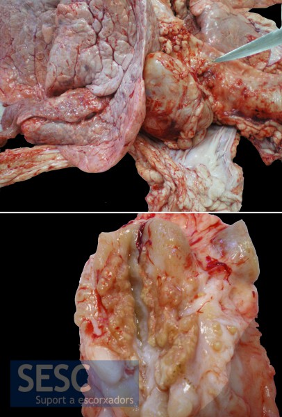 CAS 2: Lesions granulomatoses al parènquima pulmonar i als nòduls limfàtics retrofaringi i mediastínic, en un vedell mascle de raça frisona de 10 mesos d'edat. 