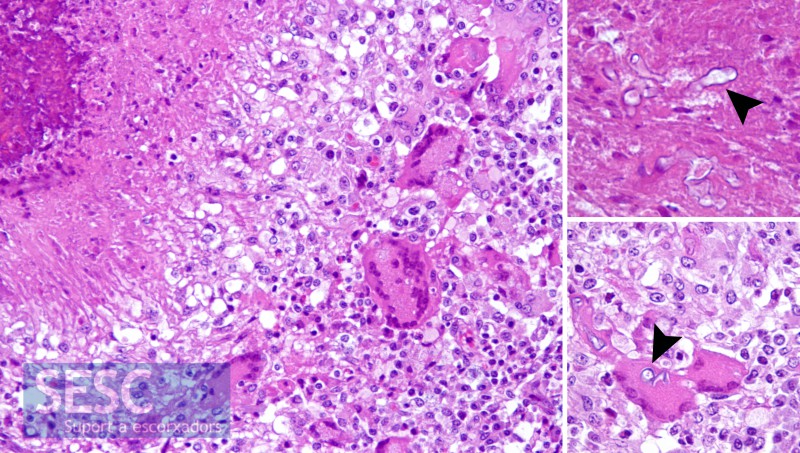 Estudi histopatològic A: Inflamació granulomatosa amb presència d'àrees de necrosi, cèl·lules gegants multinucleades i les estructures que assenyalen les sagetes (tant a la necrosi com a l'interior de les cèl·lules).