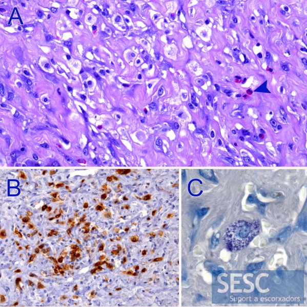 Estudio histopatológico. A: La tinción de H & E permite observar mastocitos neoplásicos rodeados de matriz fibrosa y presencia de eosinófilos infiltrando la masa (flecha) B: Estos mastocitos fueron positivos a la inmunohistoquímica para el marcador del Receptor C-kit. C: La tinción de Azul de toluidina evidencia la presencia de gránulos intracitoplasmáticos.