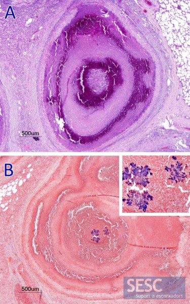 A: Granuloma pulmonar, es poden observar les capes concèntriques de material necròtic minerlitzat (de color lila fort). B: Tinció de gram que permet visualitzar creixement de bacteris gram positiu (blau fosc) al centre d'un dels granulomes. La morfologia de la colonia és caracteristica de Corinebacterium pseudotuberculosis. 