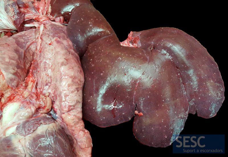 Lesiones granulomatosas de distribución miliar en el hígado.