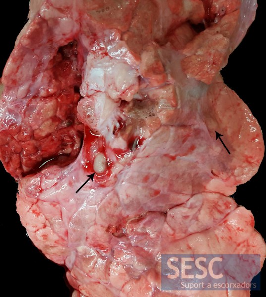 En el pulmón también se observan lesiones de aspecto granulomatoso (flechas).