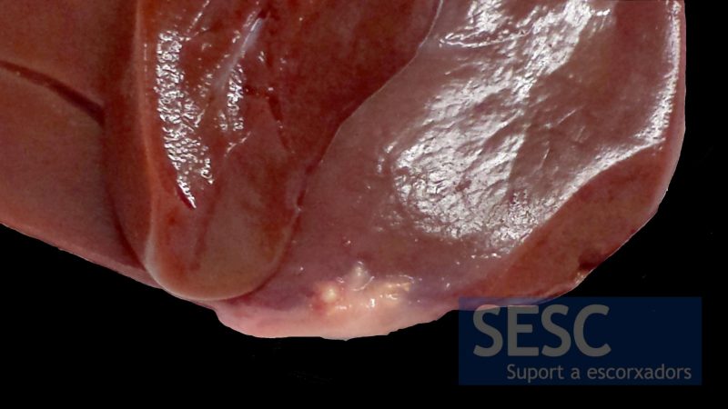 Granulomatous lesion in the liver parenchyma.